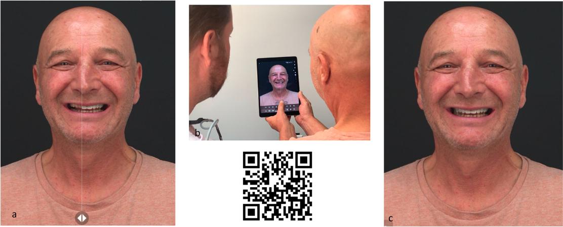Fig. 4 Co-diagnostic session using an augmented reality protocol. a. Real-time superimposition of the virtual mock up. b. Discussion platform offered by the augmented reality tool. c. Commonly chosen smile projection
