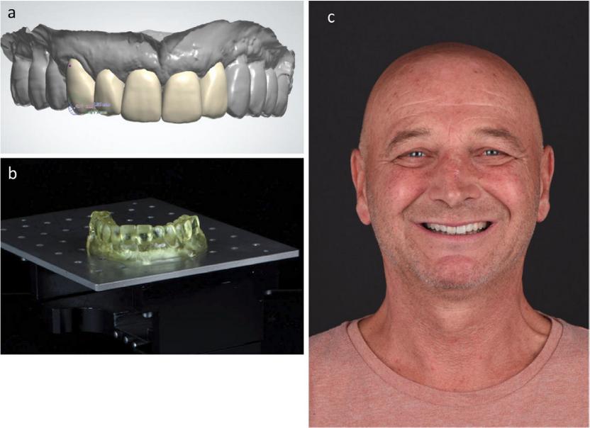Fig. 5 Virtual conception to physical mock-up. a. Digital wax up using the AR smile projection. b. 3D-printed model of the digital wax up. c. Validation using a physical mock-up