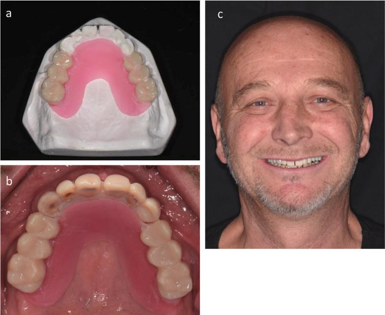 Fig. 2 Conception and reconstruction of posterior teeth. a. Setup of the posterior teeth. b. Intraoral view of the try-in of the setup. c. Frontal view