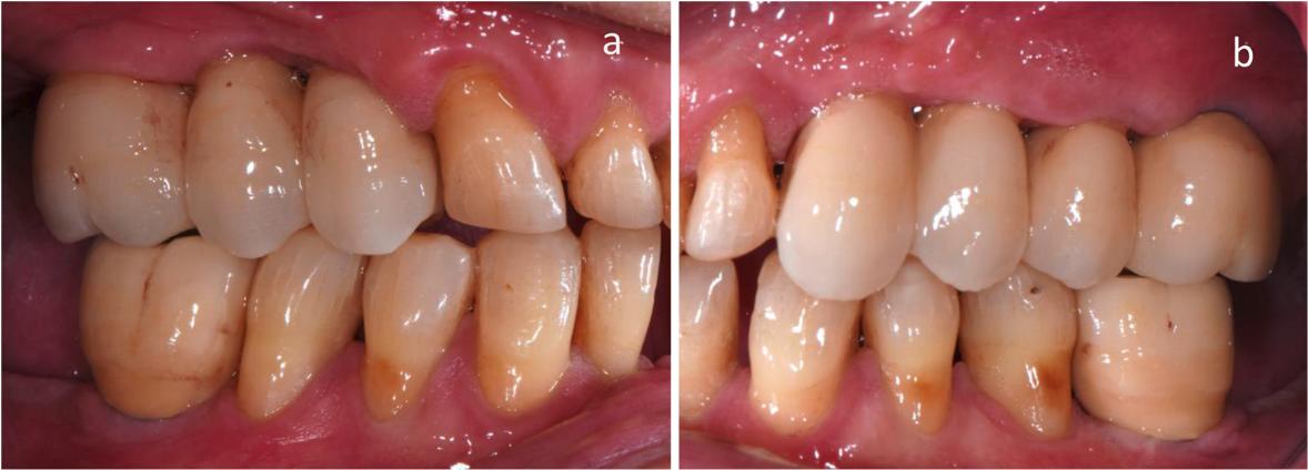 Fig. 3 Intraoral view of the implant-supported reconstruction of the posterior teeth. a. Right. b. Left