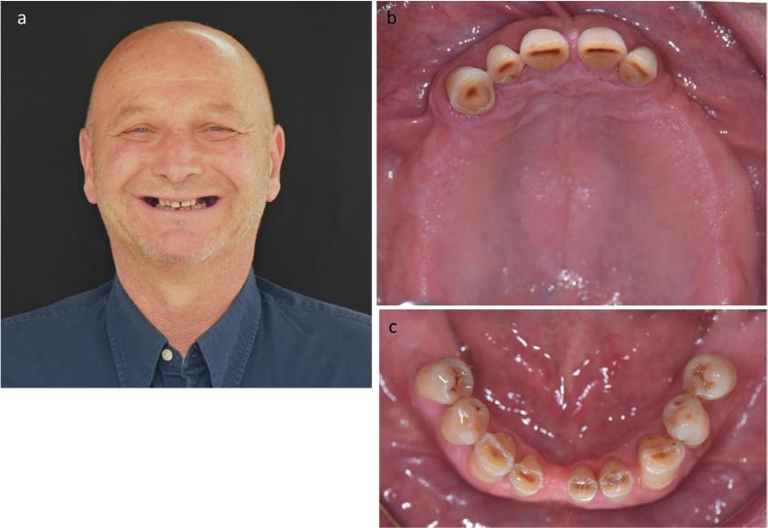 Fig. 1 Initial situation. a. Frontal view. b. Occlusal view of the upper arch. c. Occlusal view of the lower arch